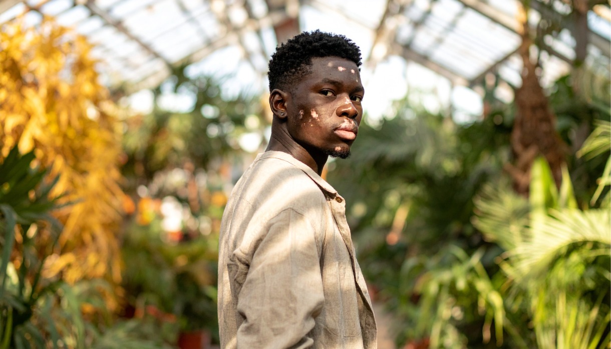 Young man with vitiligo in sunlit greenhouse